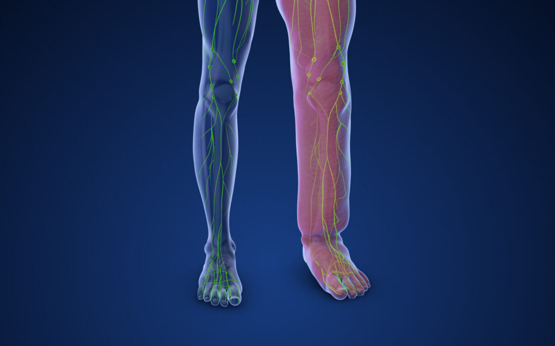 Lymphedema Wraps: Understanding Their Importance and How Home Health Care Can Help